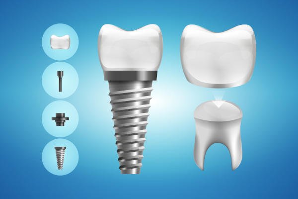 dental implant planning